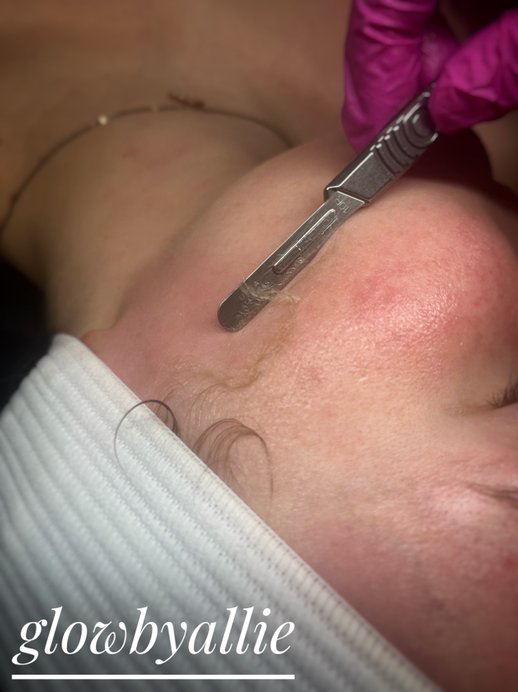 Dermaplane add on
