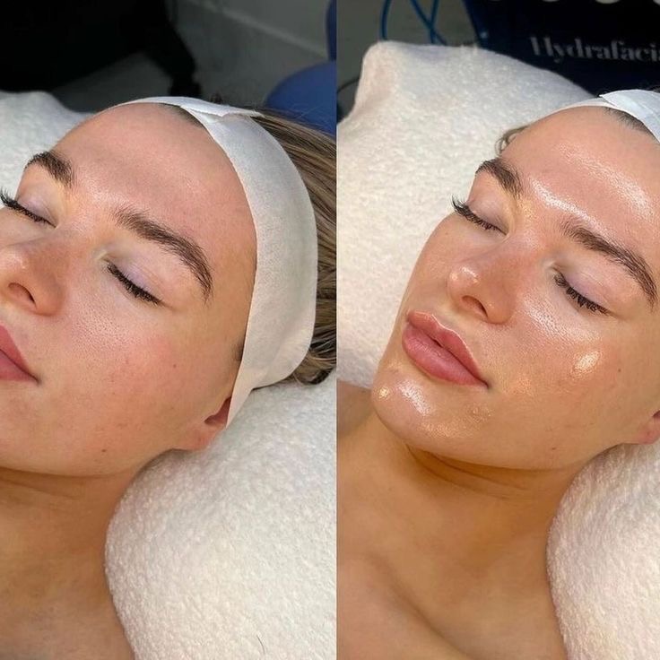 Hydrafacial - Platinum