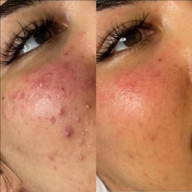 Acne Bootcamp Treatment Ritual at Xo Nail Salon in Watseka, IL