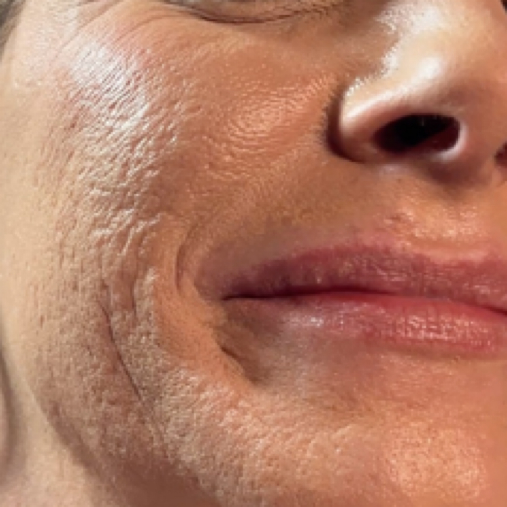 Radio Frequency  Microneedling Face at Southern Sparkle Medical Aesthetics in Swainsboro, GA