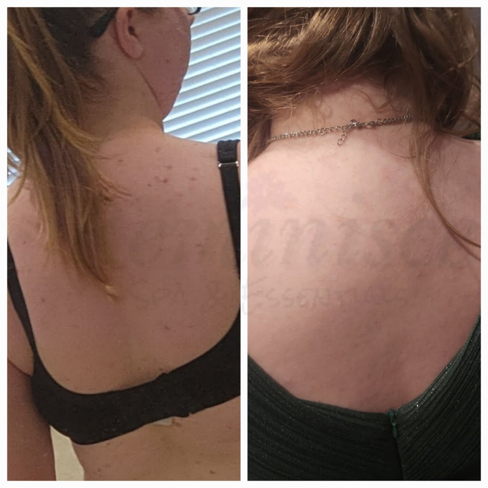 Back Microneedling