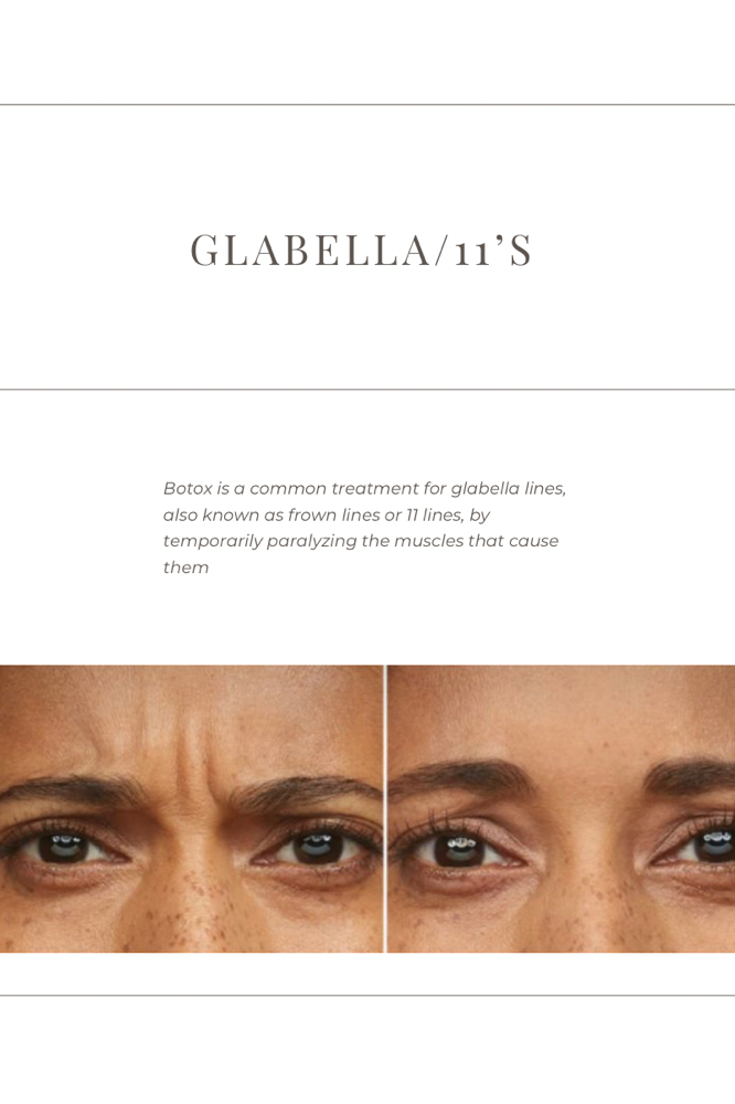 Glabella/ 11s