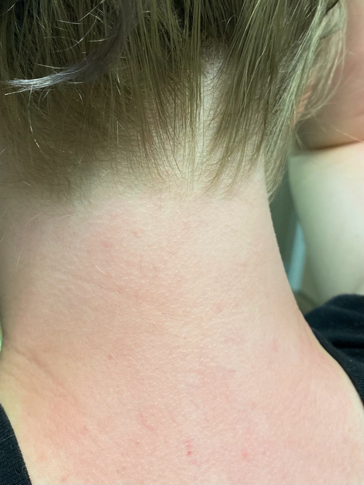 Hairline at Bare Esthetics & Wellness in Greenville, NC