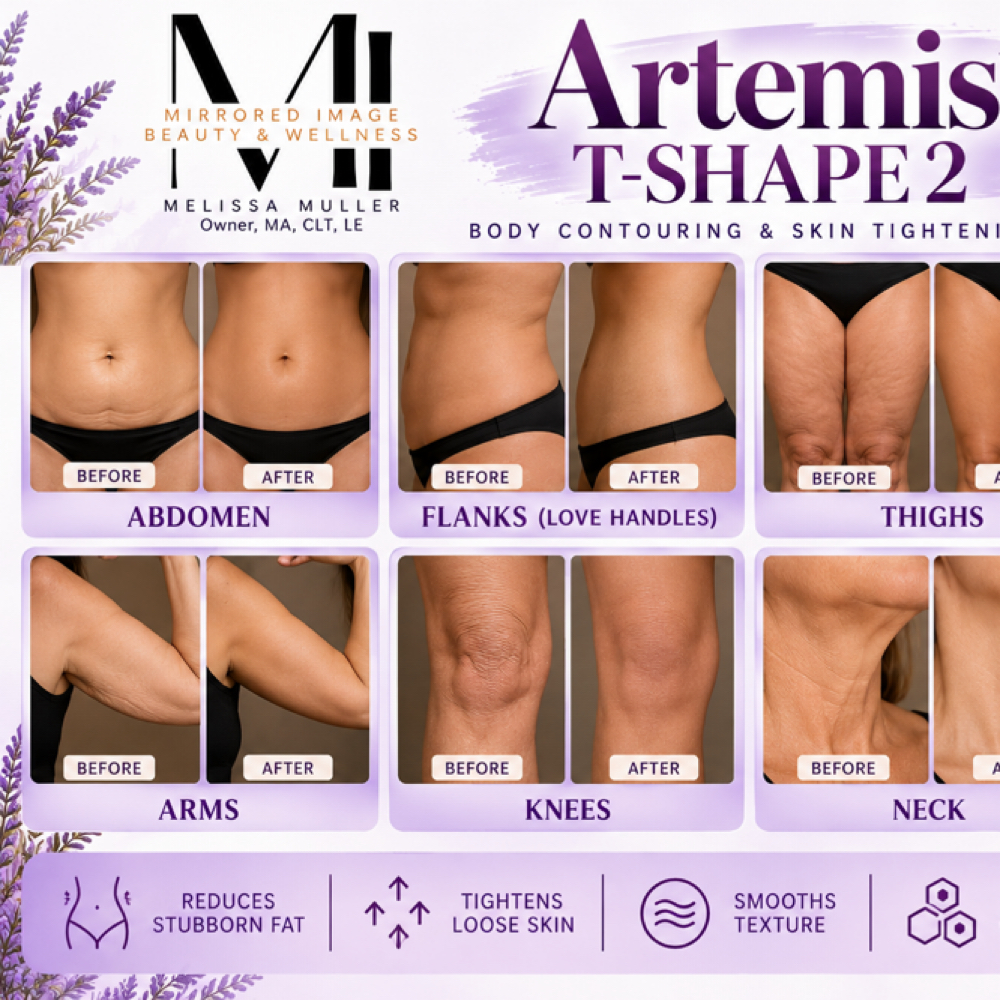 Artemis T- Shape 2 - Abdomen + Flanks/Love Handles at Mirrored Image Beauty & Wellness in Oconomowoc, WI