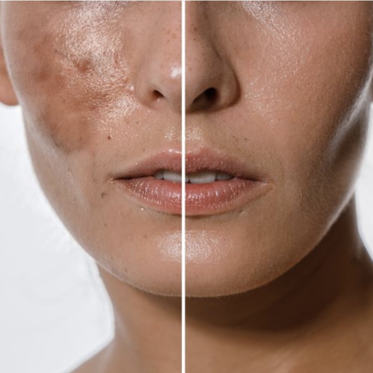 Tier 3 Facial - Advanced Correction