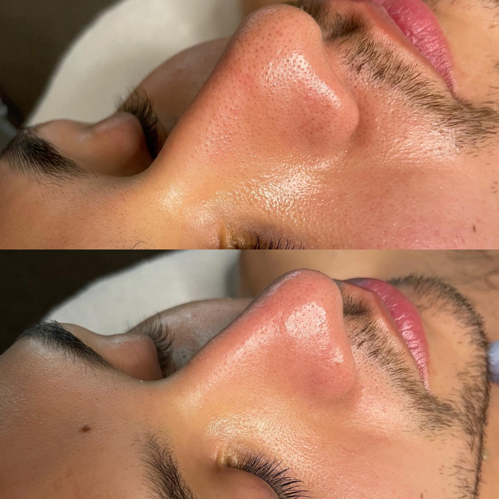 Men’s Rejuvenation Facial