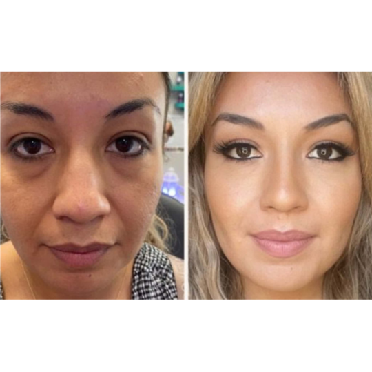 Filler 3 Syringes Facial Balancing at EVERWELL LUXE in Kissimmee, FL