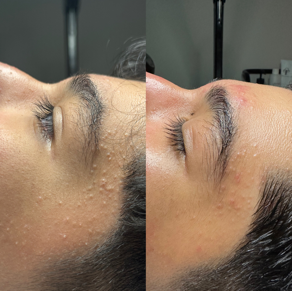 Acne Facial
