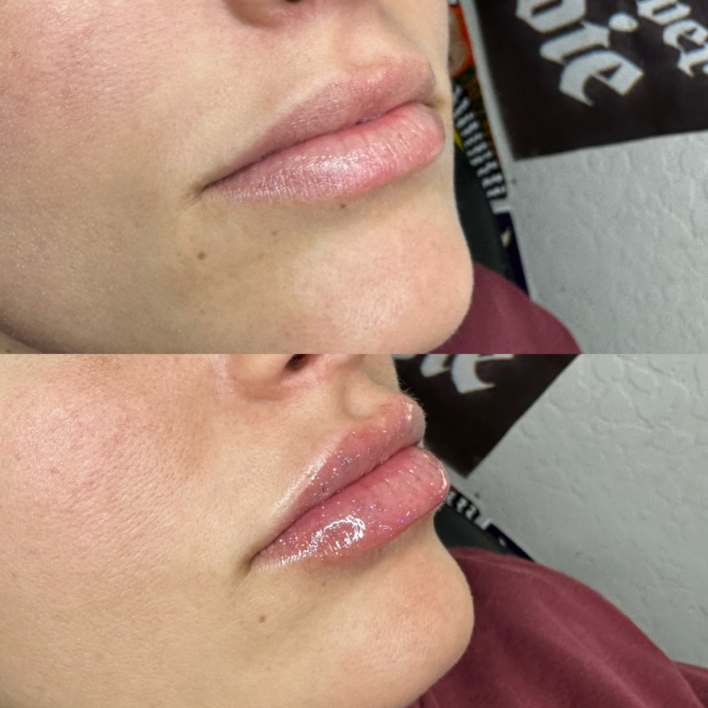 Group Lip Filler (2)