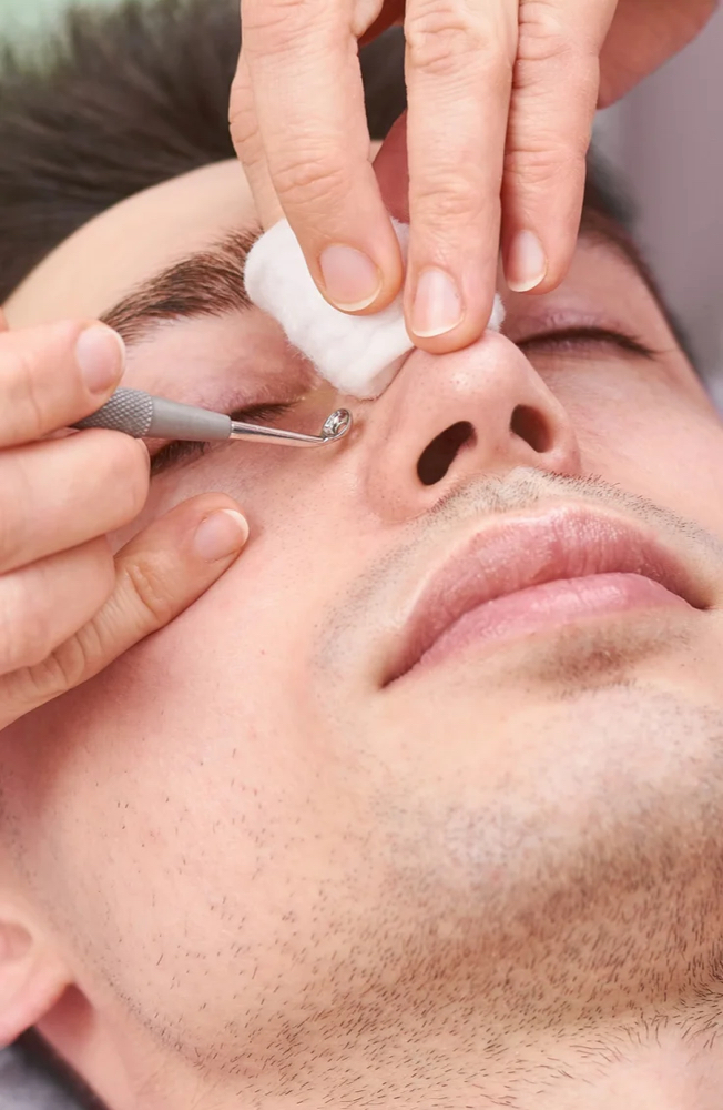Blackhead Removal