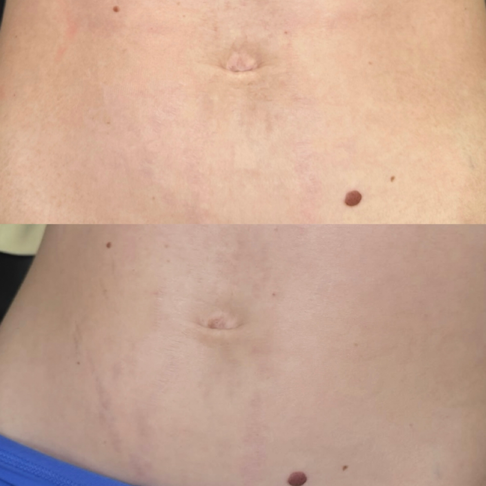 Scar/Burn/Stretch Mark Revision at Katelyn Kosmetic in Boise, ID