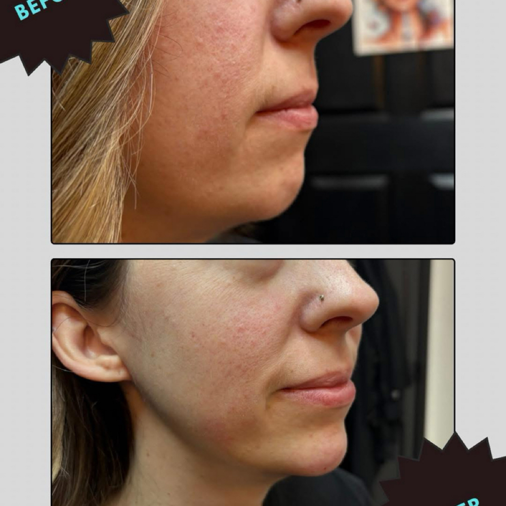 Chin Filler at Elevate Skin Lab in Desloge, MO