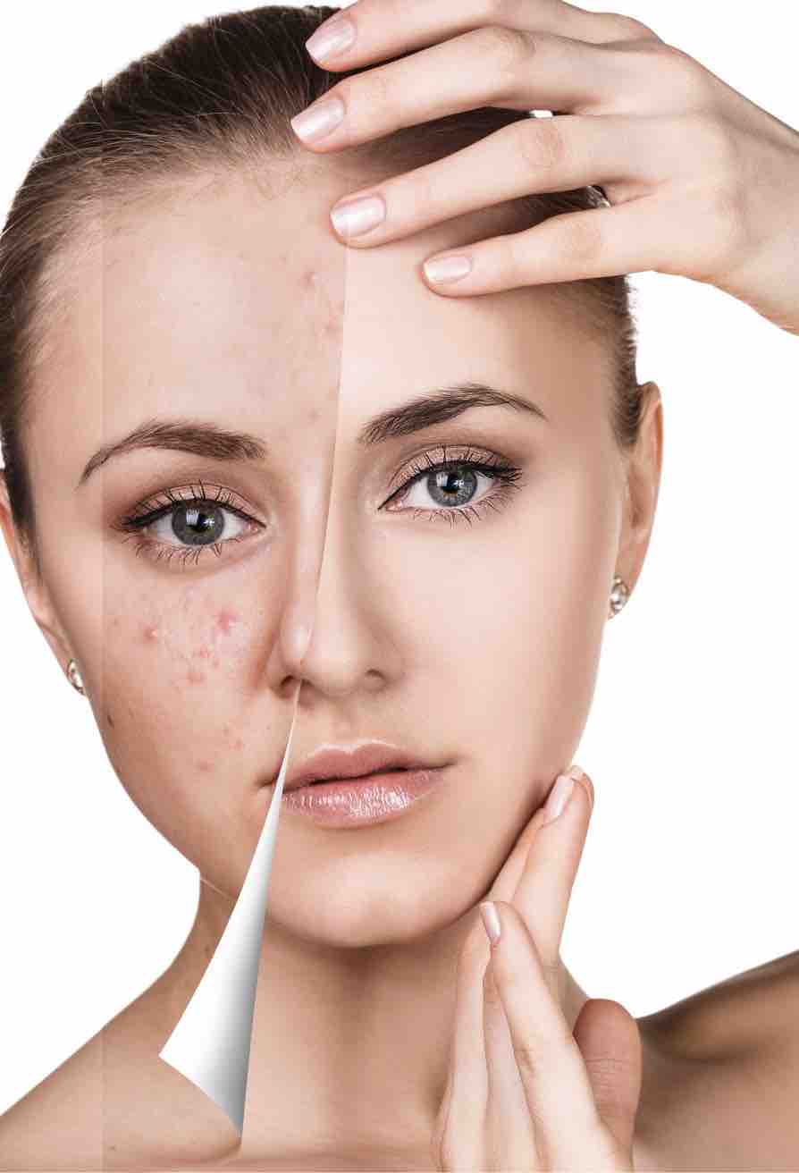 Purifying Acne-Facial 90 minutes