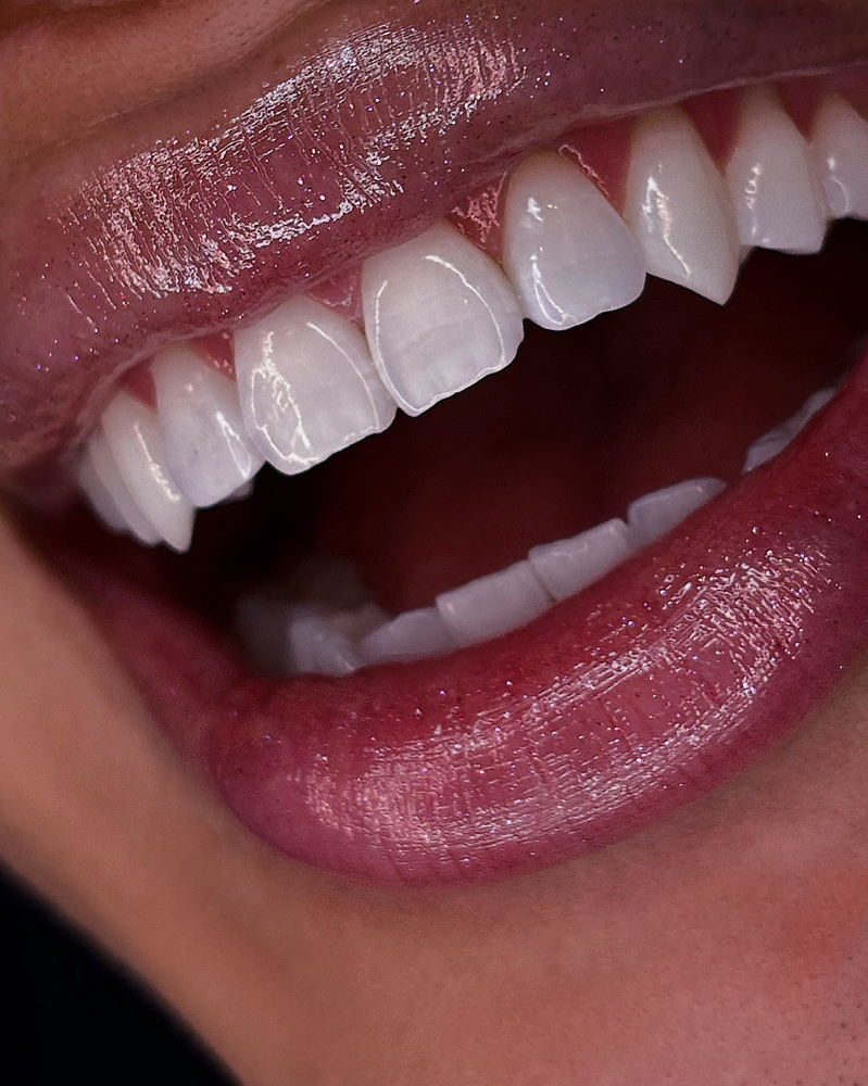 1 Hr Teeth Whitening