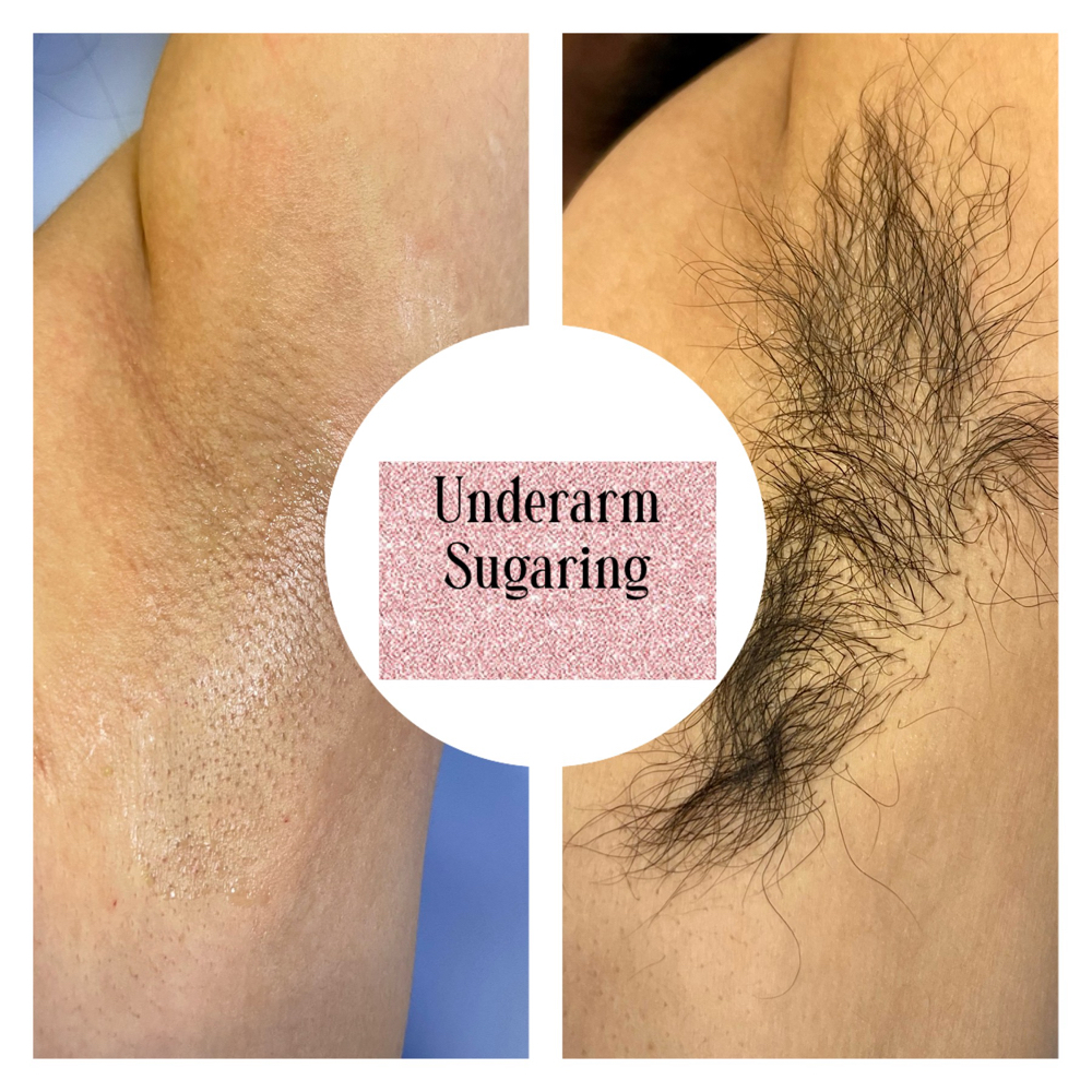 Underarm Sugaring