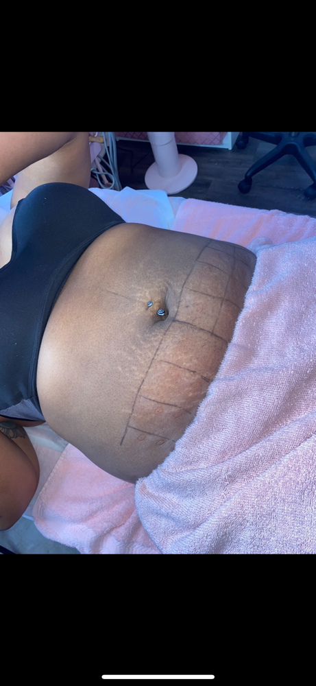 Liposhots Half Abdomen