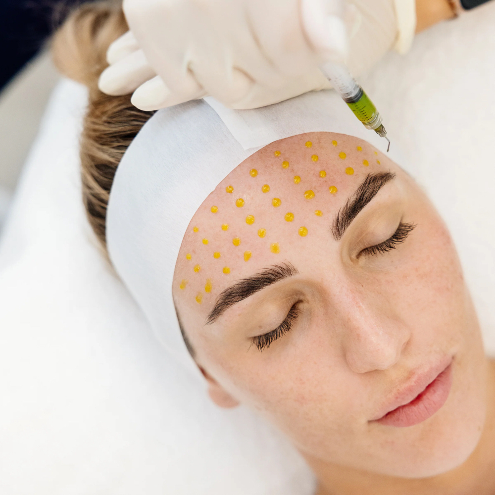 BioRePeelCl3® Treatment (Existing C