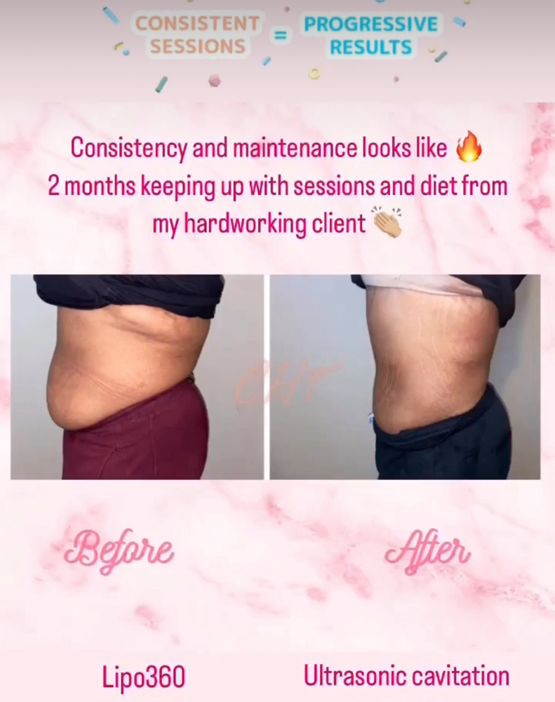 6 Session Package Lipo360 + BBL