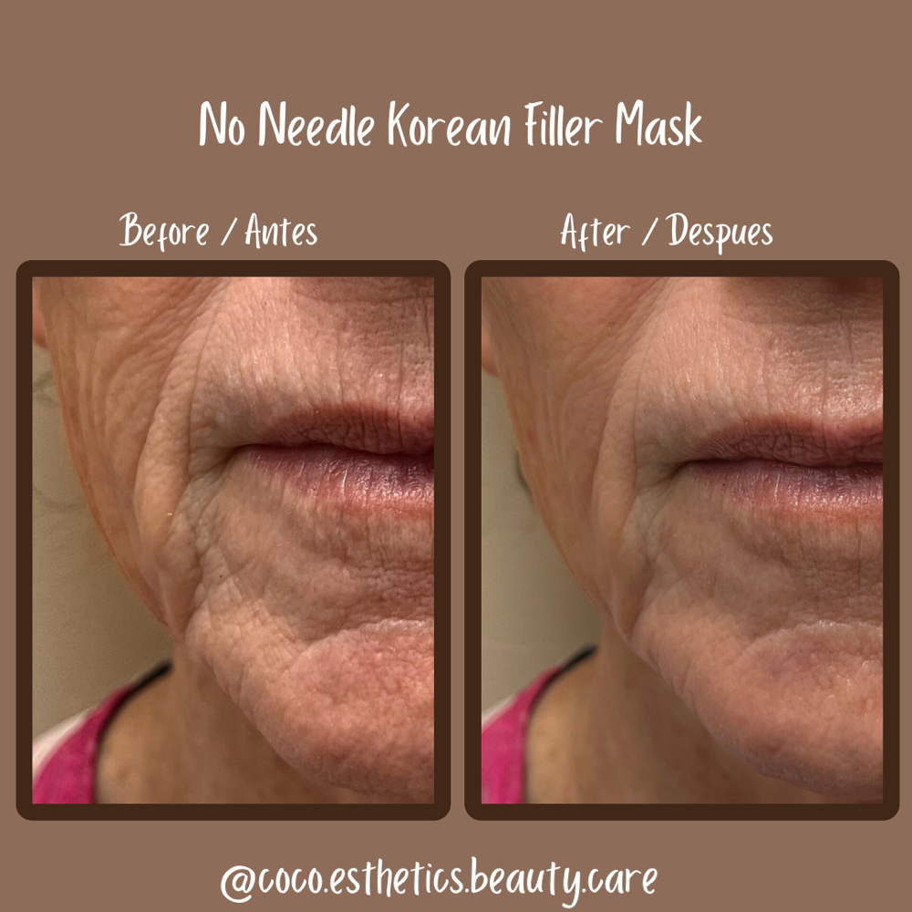 No Needle Korean Filler Treatment