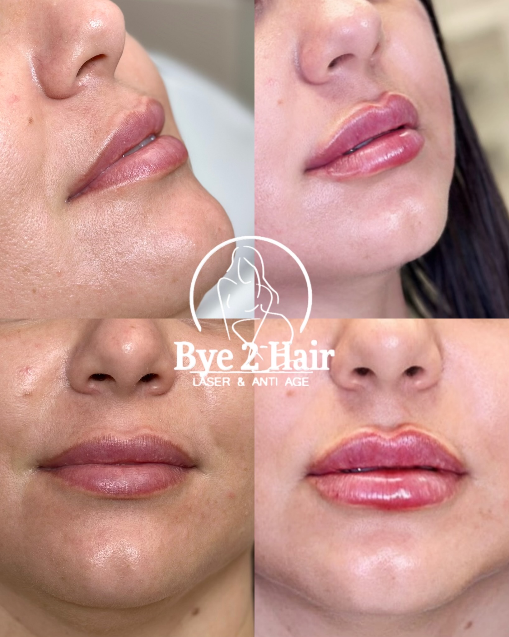 💉 Lips Augmentation