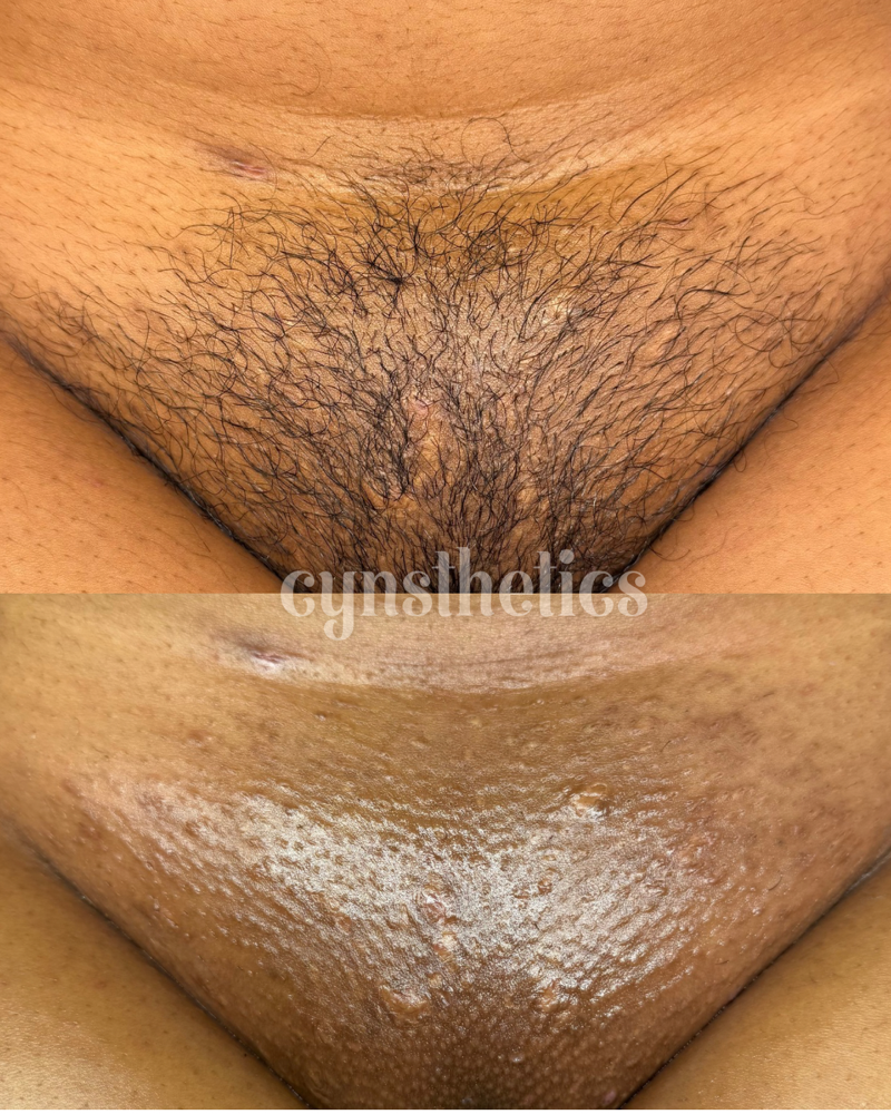 full brazilian at Cynsthetics Skincare in Brooklyn, NY