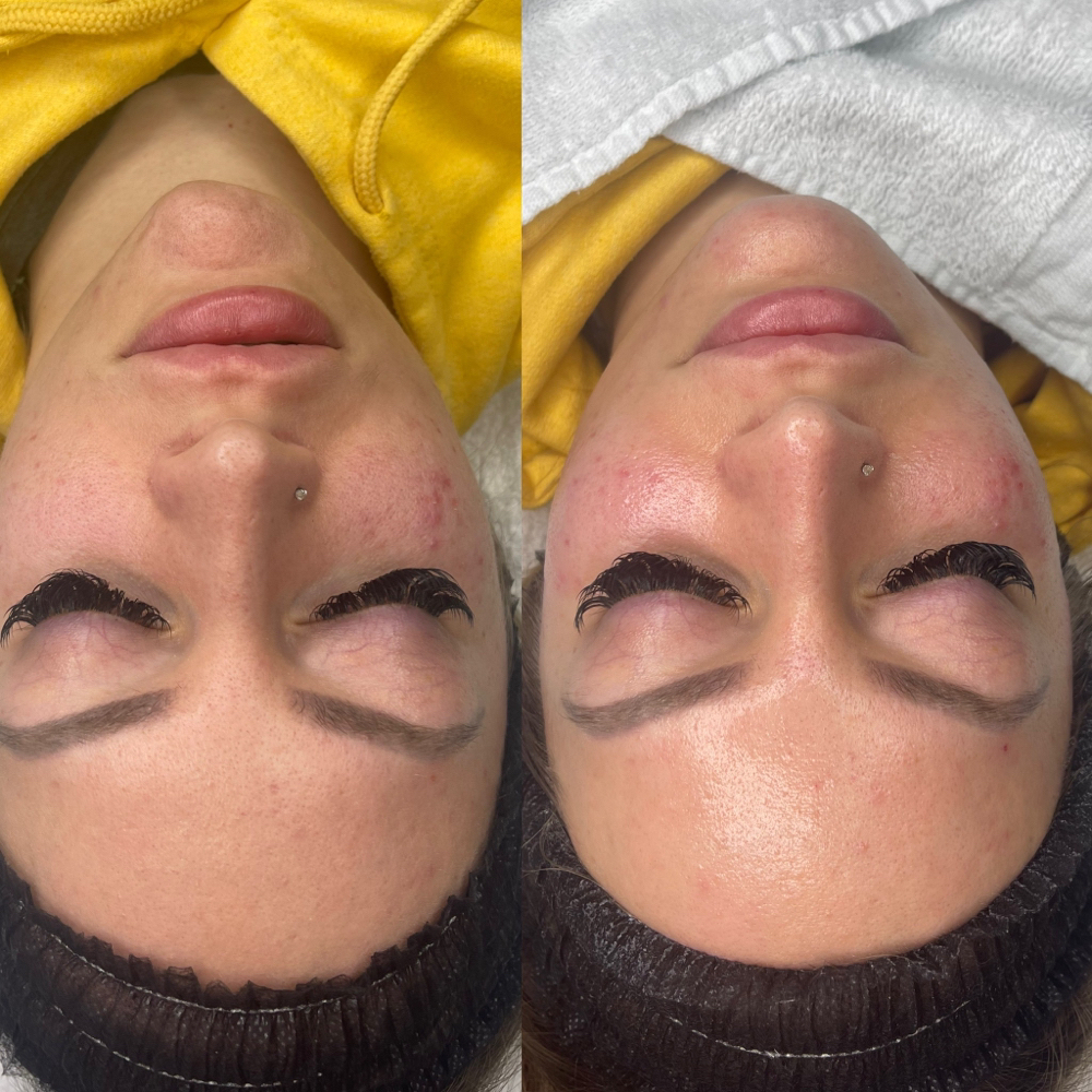 20% LACTIC PEEL