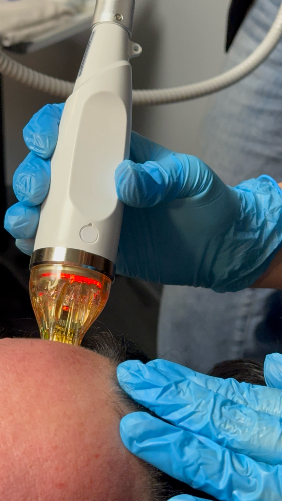 Microneedling treatment