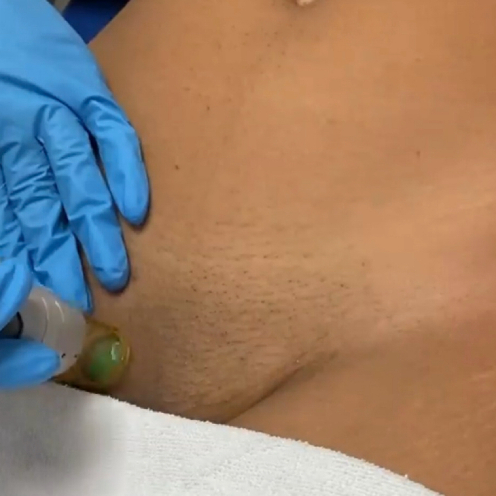 Brazilian/Laser Hair Removal at Gigi’s Beauté LLC in Lanham, MD