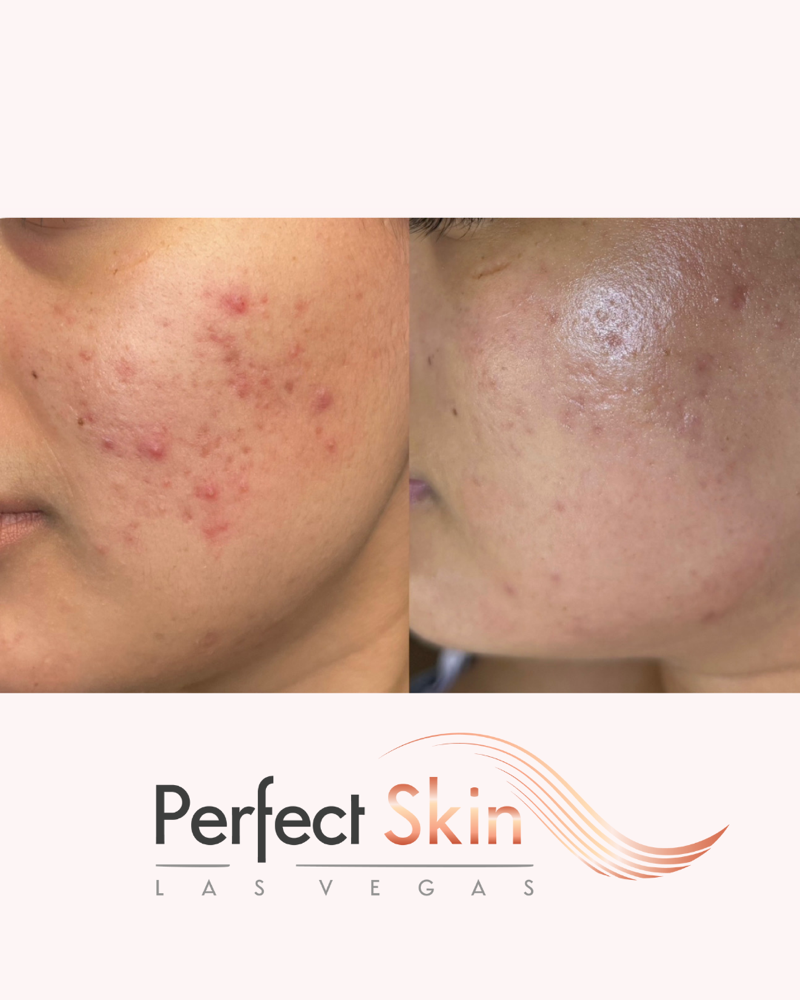 Acne Facial