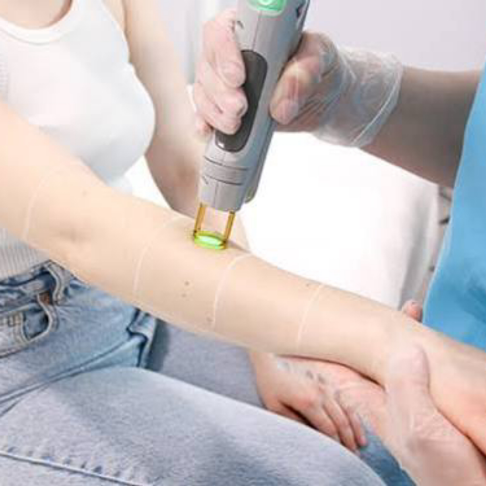 Laser Hair Removal Full Arms at All Aesthetics Kare in Upland, CA