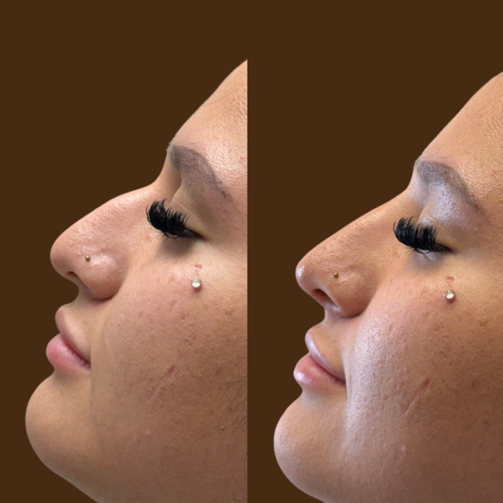 Nose Filler at Aether Aesthetics in Midland, TX