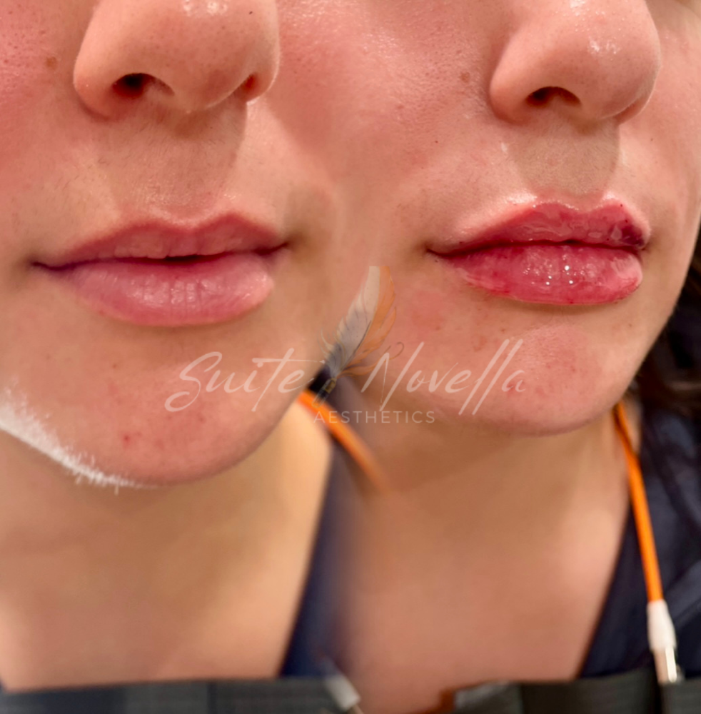 Lip Filler – Full Syringe (1mL)