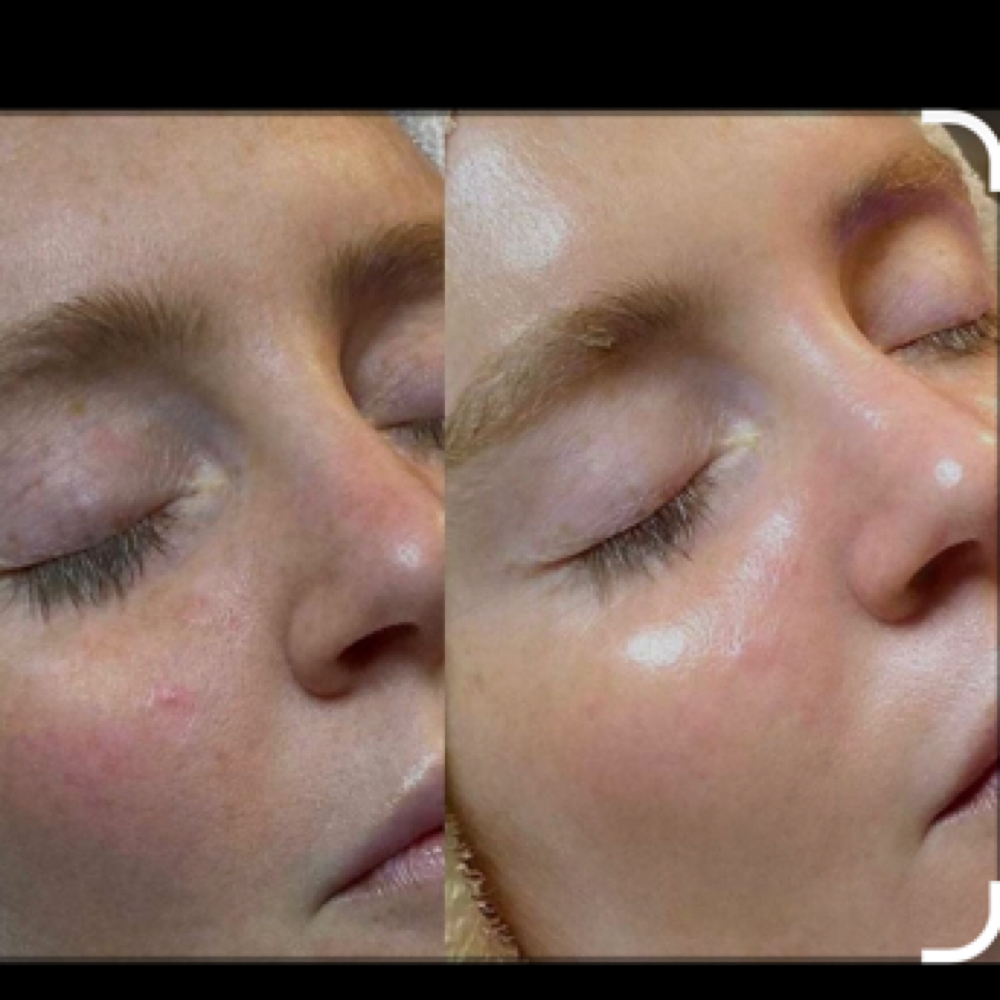 Hydroderabrasion at Genie of Skin in Mooresville, NC