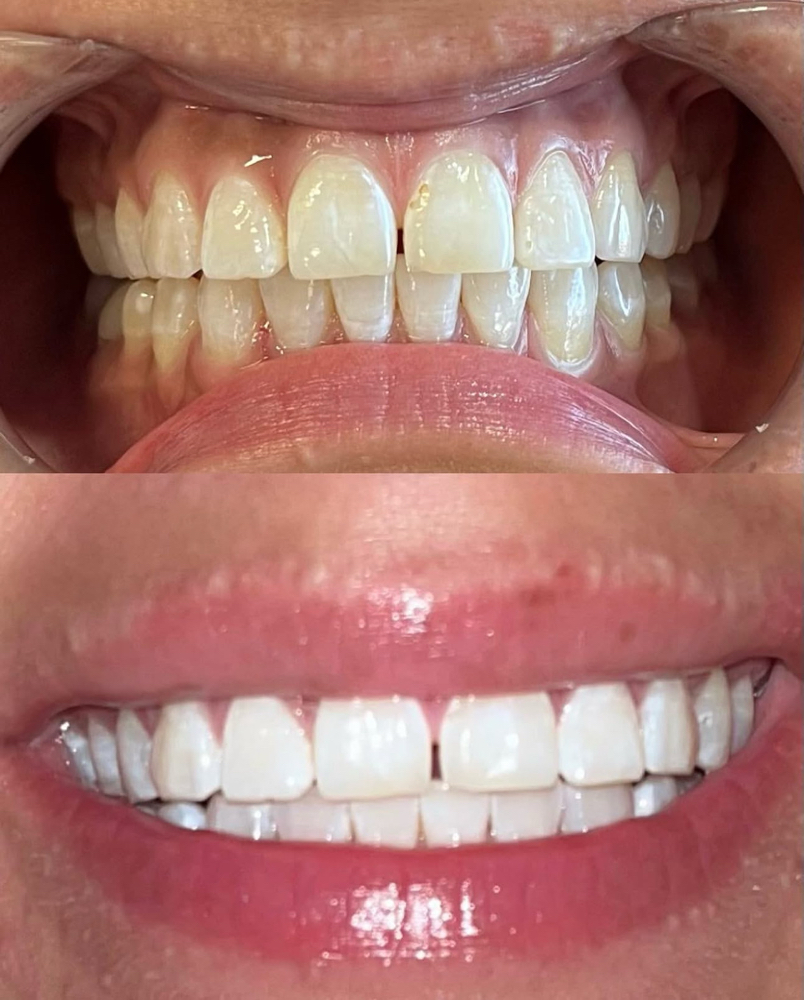 Diamond White Teeth Whitening at MK Beauty Salon in Salamanca, NY