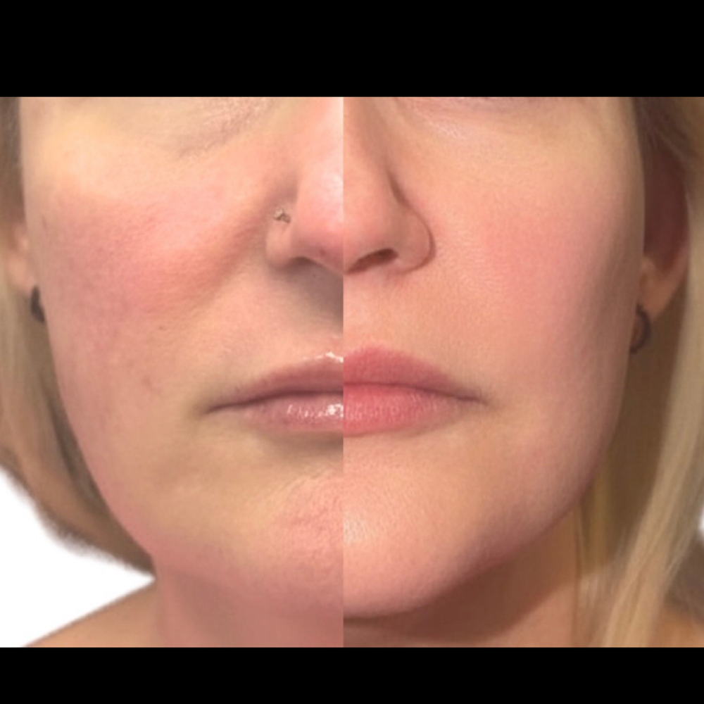 Facial Filler at Injections by Leighanna in Clarksville, IN