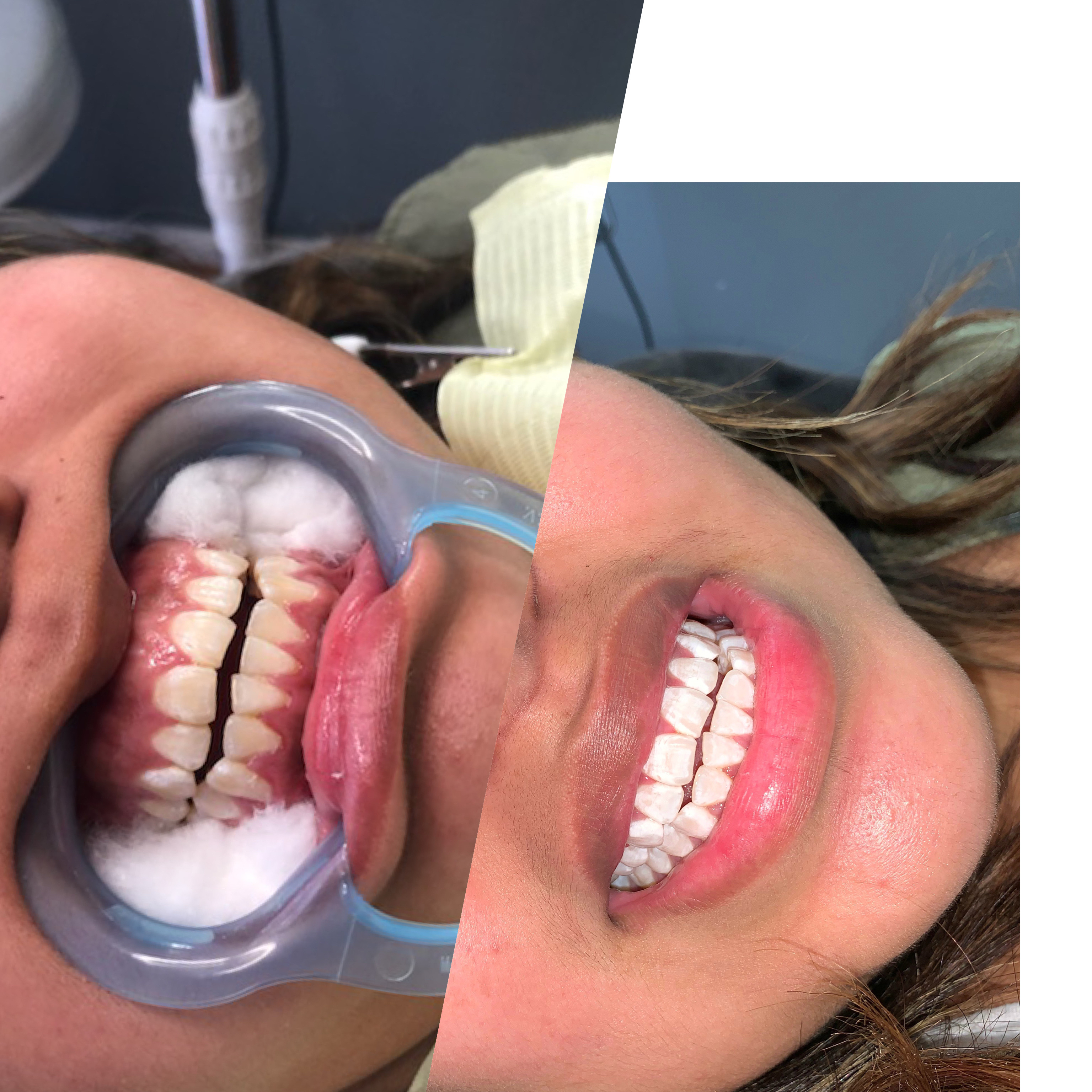 Queen Smiles LED whitening 60 Mins