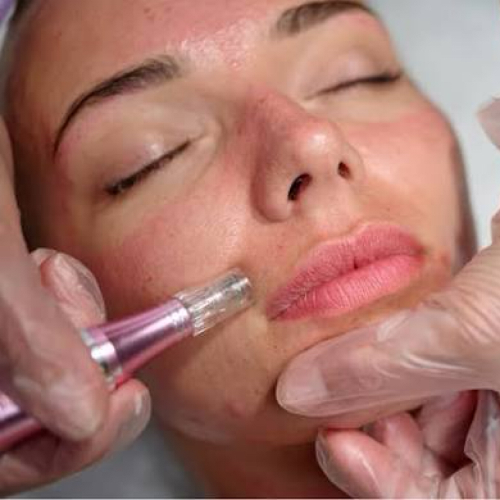 Youthful Kiss Microneedling
