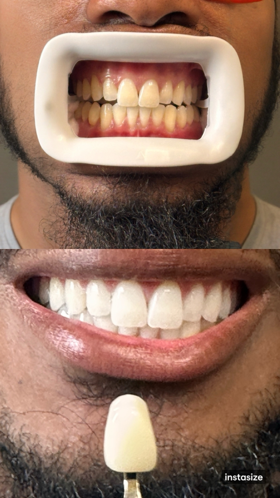 Refill Whitening Gel Pen