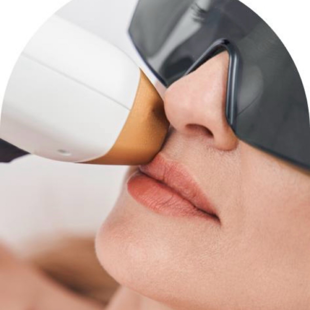 Laser Upper Lip at La Belle Studio by Soraya in Woburn, MA