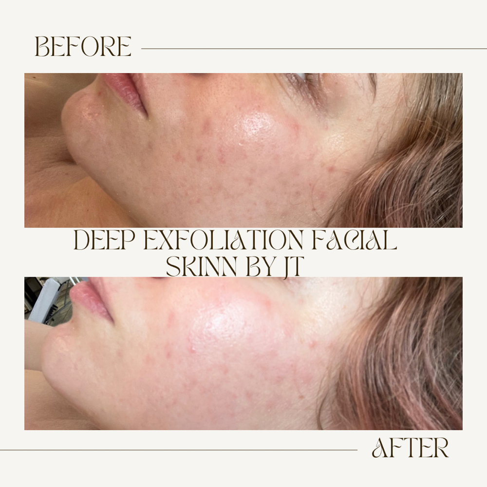 Deep Exfoliation Facial