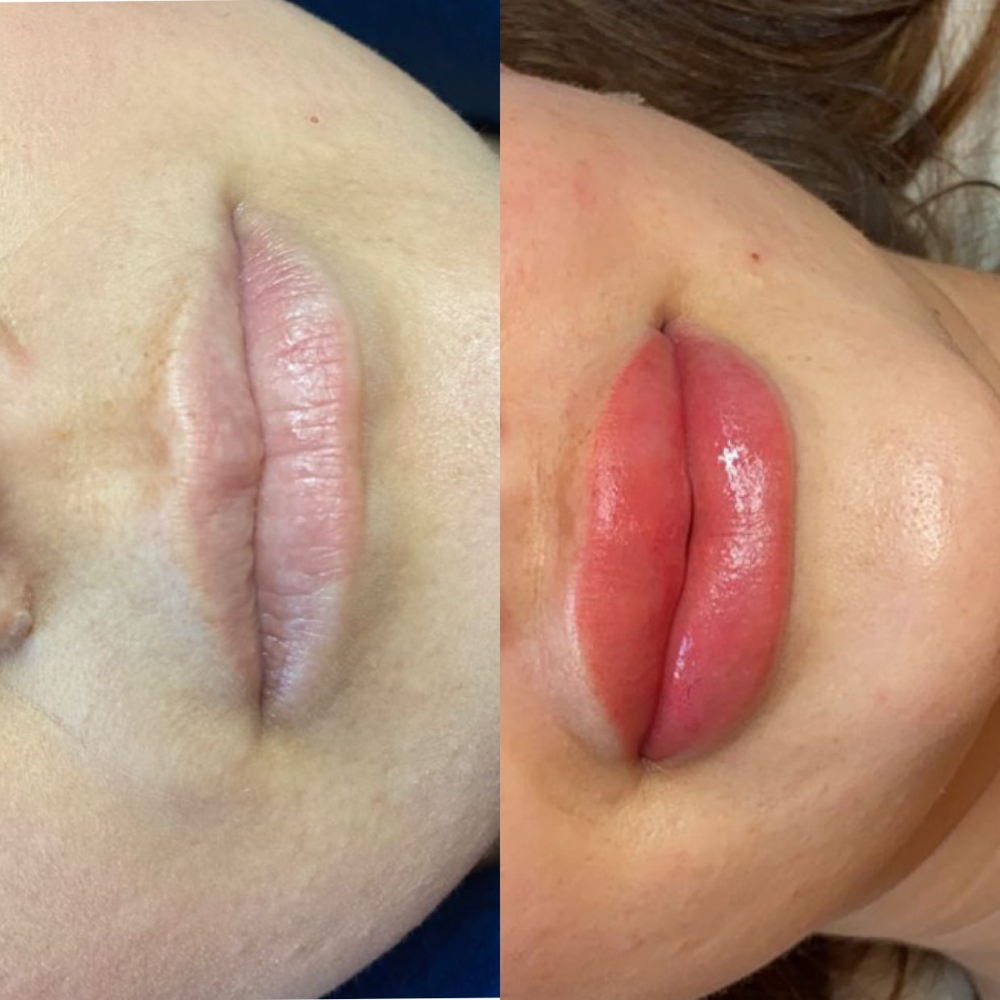 MicroLips