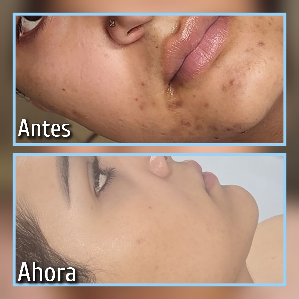 Meso Facial