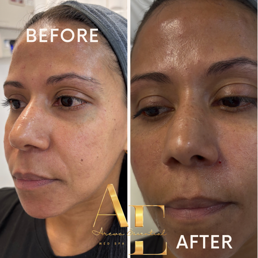 Nasalabia Fillers at Arewa Essential Medspa in Mamaroneck, NY