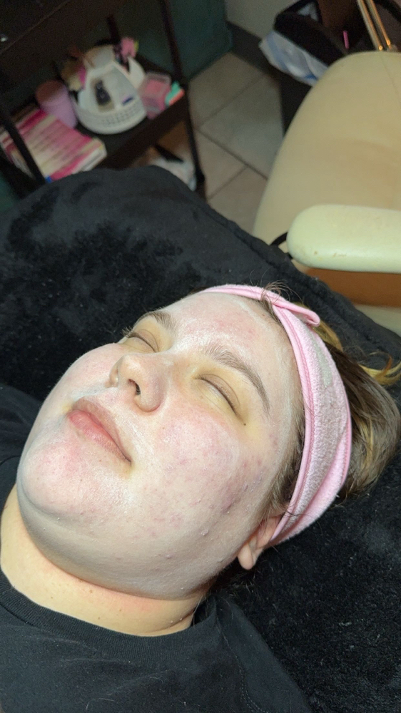 Lactic Acid Peel