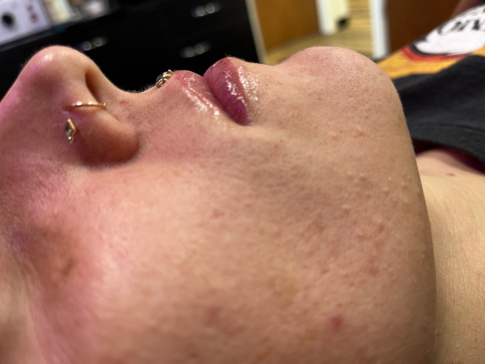 Hyaluron Lip Filler
