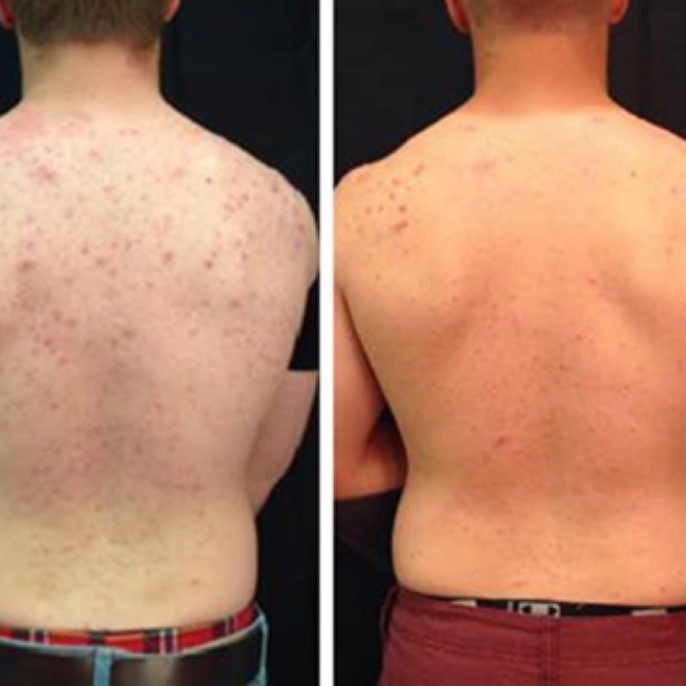 Back Acne Monthly Treatment at Glow Aesthetics in Temecula, CA