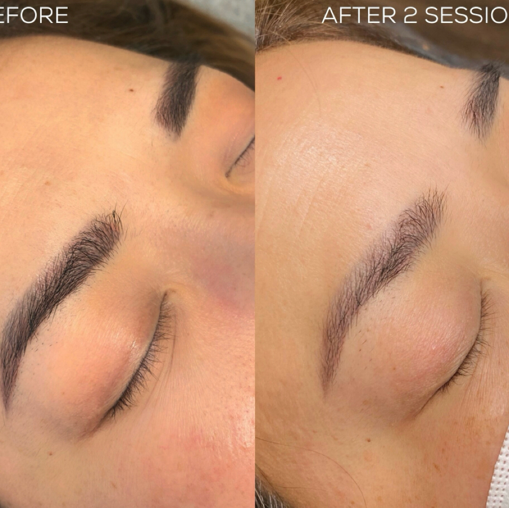 PMU Tattoo Removal at Pride Beauty Studio in Concord, NC