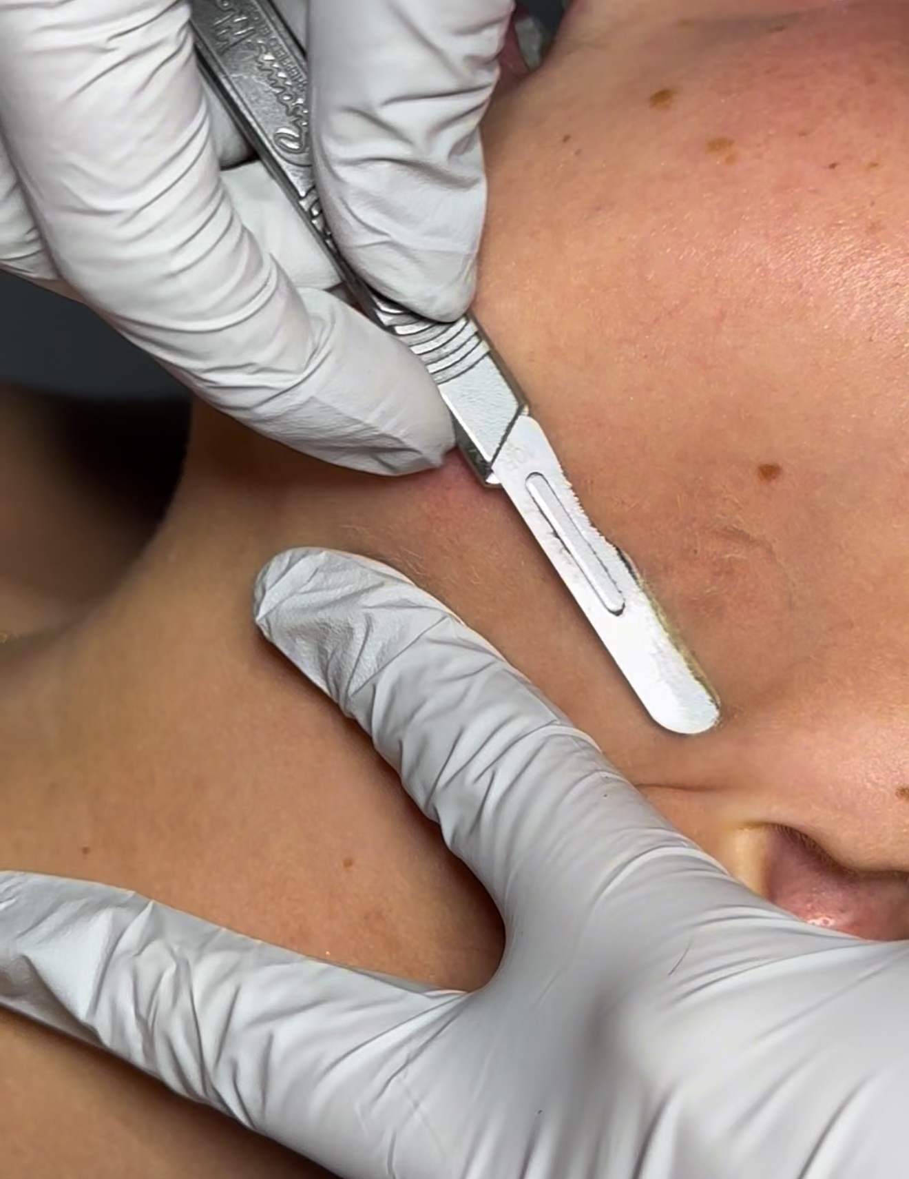 Dermaplane - Add On