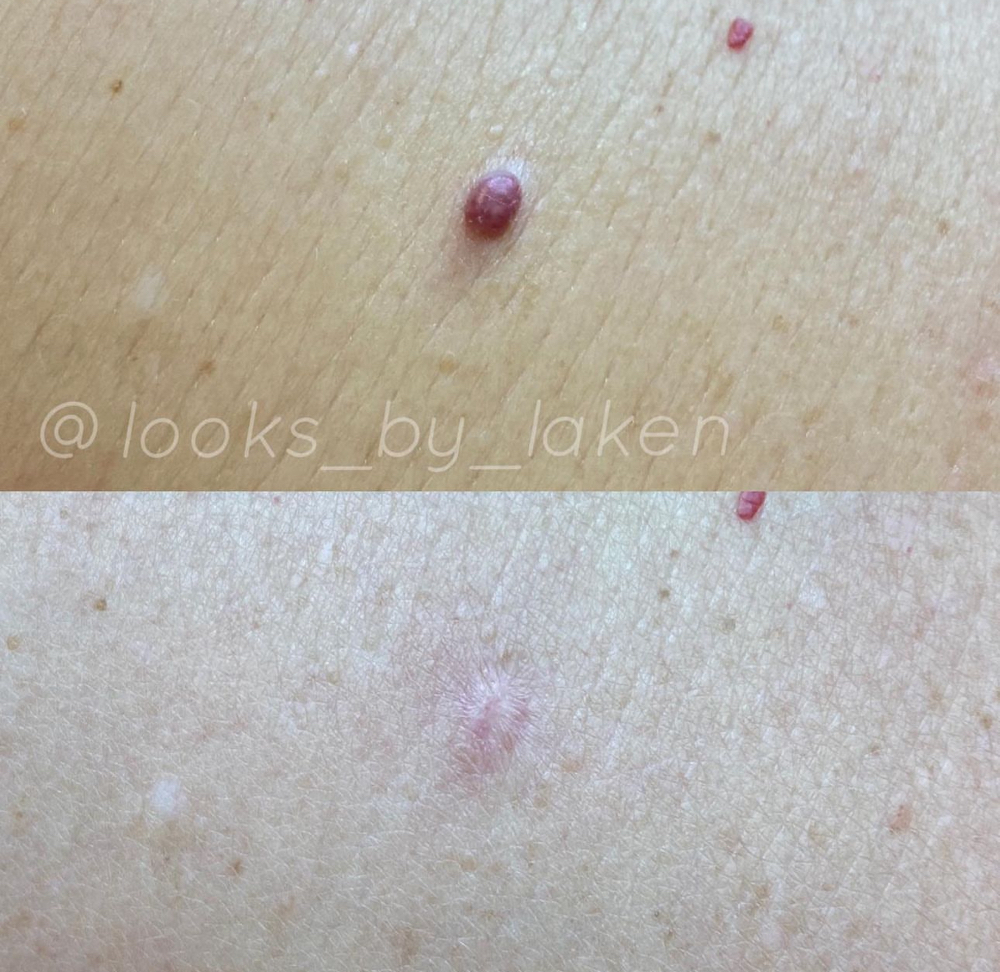 Skin Tag/Mole Removal