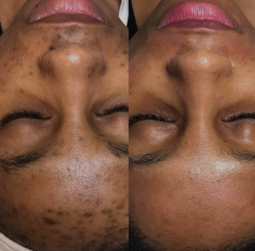 Chemical Peel